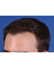 After Hair Transplant&nbsp;Hairlines